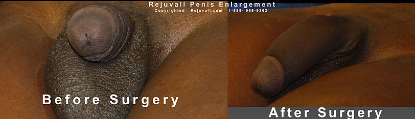 Before And After Pics Of Penis Enlargement 50