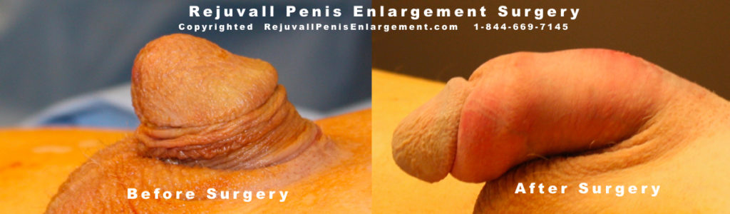 Penis Enlargement Surgery Costs 46