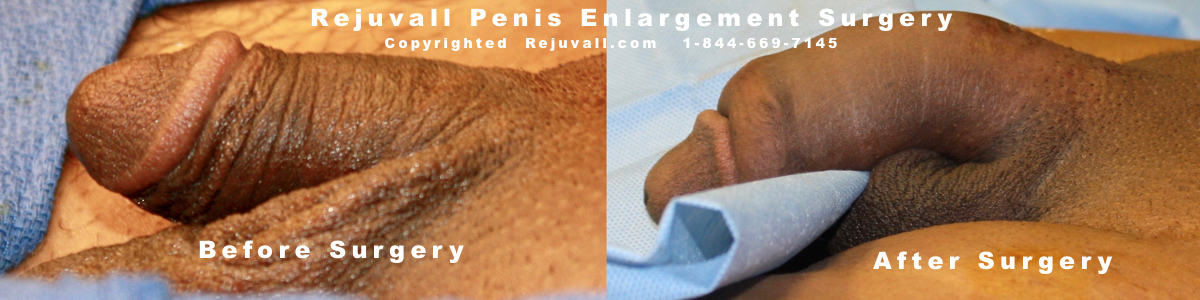 Free Penis Enlargements 26