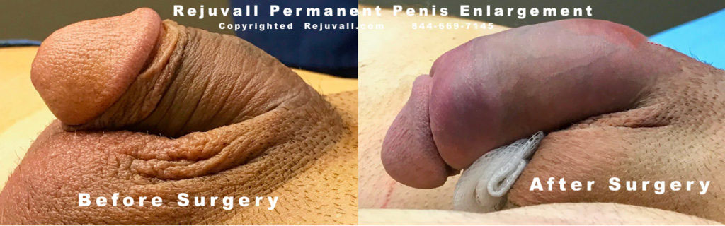 Pictures Of Penis Enlargement Surgery 100