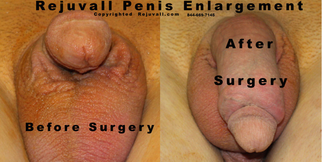 Weird Ways Men Try To Enlarge Their Penises