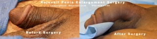 penis enlargements before after pics