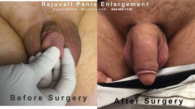 penis enlargement surgery photo before and after