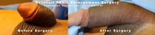penis augmentation photo before after