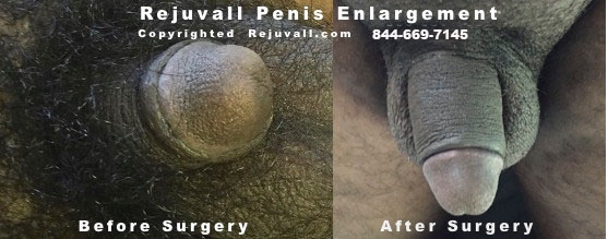 photos micro penis surgeries