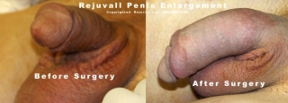 erect small penis before after pics