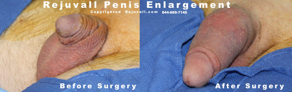 micropenis short elongated after surgery