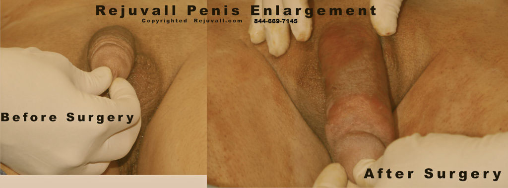 micro penis elongated after surgery large