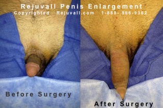 thickness length penile enlargement