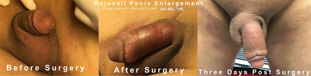 photo buried penis 3 days after surgery
