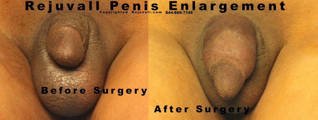 after surgery girth widening