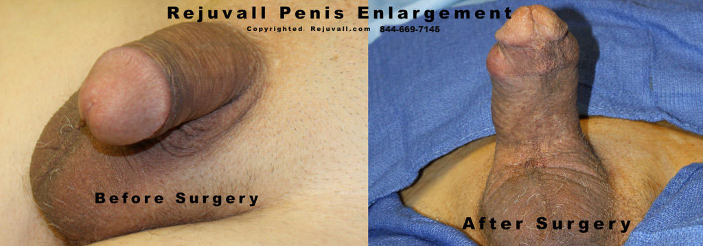 before after micropenis operation photos