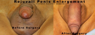 longer penis after surgery