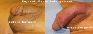 post surgery dramatic penis enlargement