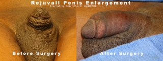 micropenis surgery before after pics