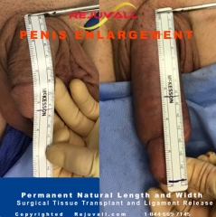 penis enlargement before after pics