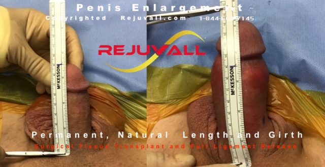 b4 after penis circumference pics
