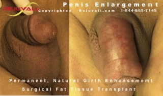 before after girth increase penis
