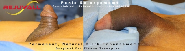 penile pics before after surgery