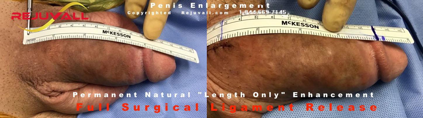 before after increase inches penis