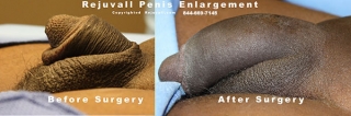 enlargement penis surgery pics
