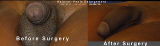 penis growth after surgery image