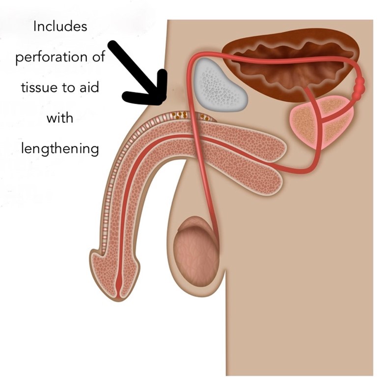 penile-repositioning-procedure