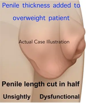 fat pad and penis extension surgery