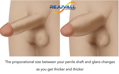 before after penile thickness surgery pics