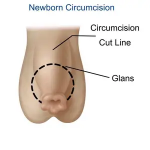 circumcision at birth complications penile surgery