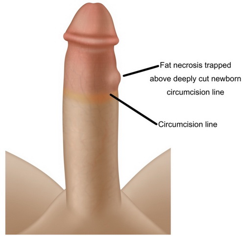 penile girth enlargements circumcision