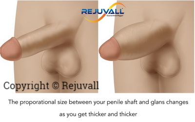 before after penile thickness surgery pics