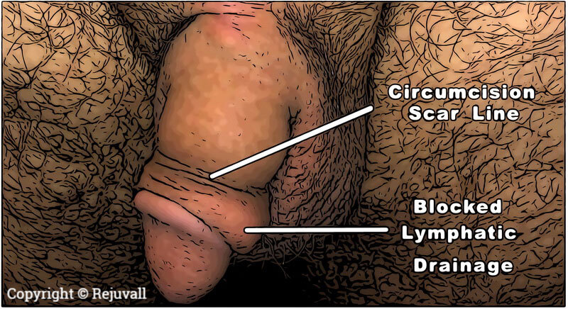 penile girth enhancement and circumcision