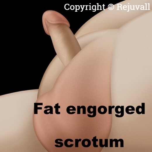 penile lengthen with fat engorged scrotum