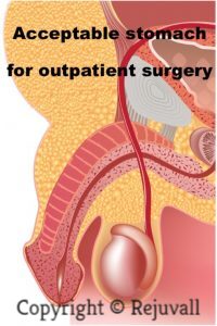 outpatient surgery correct buried penis