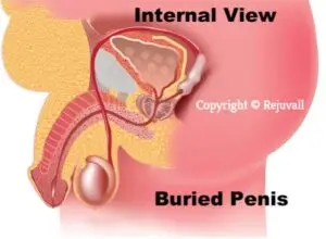 medical illustration cross section of the male human body of an overweight man showing a side internal view of a buried penis caused by obesity