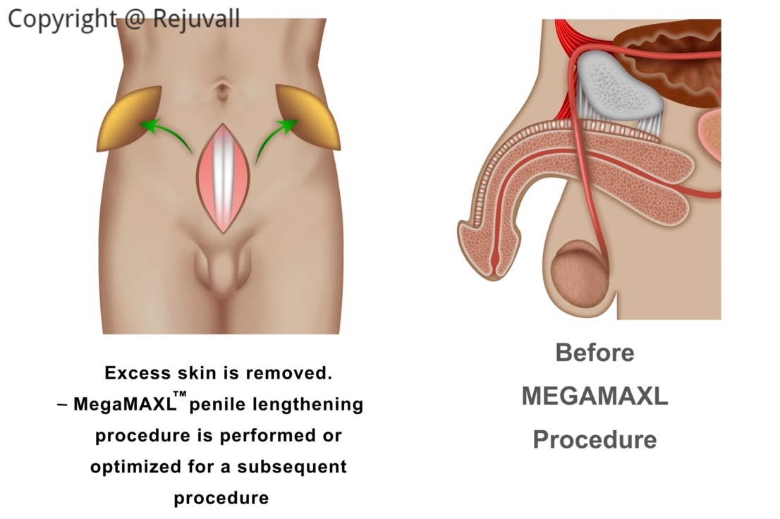 Penile lengthening with liposuction illustrations