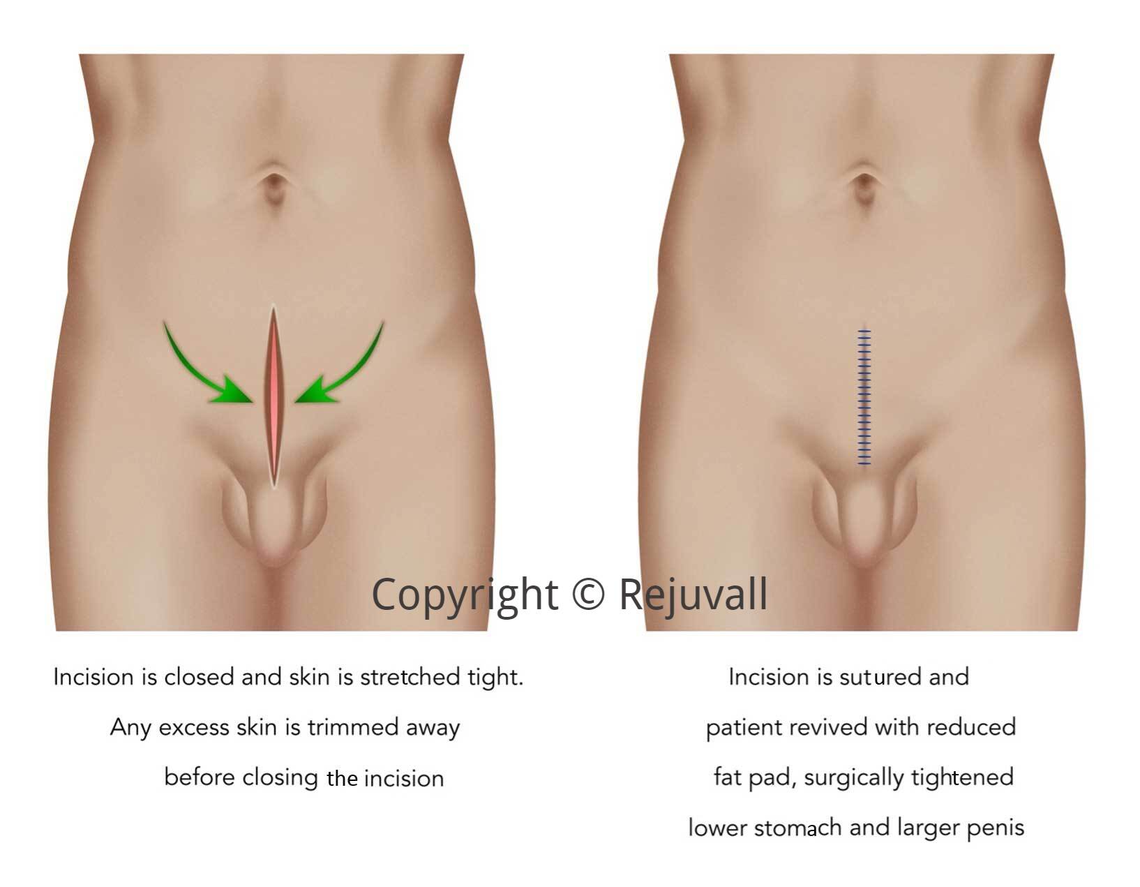 penile lengthening fat pad removed