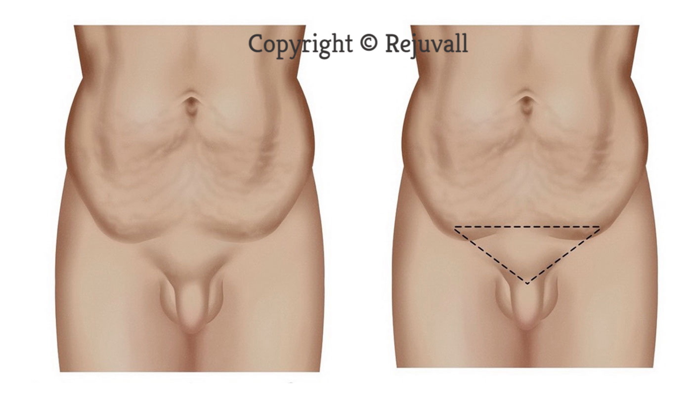engorged fat pad correction enlarged penis
