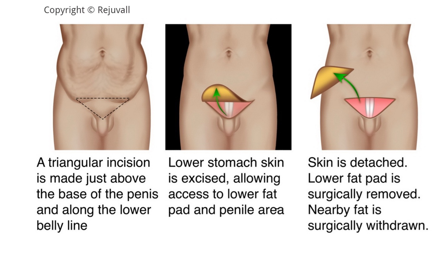 outpatient penis surgery remove fat pad lower stomach