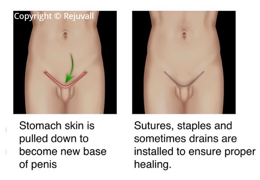 picture of lengthening penis fat pad removal