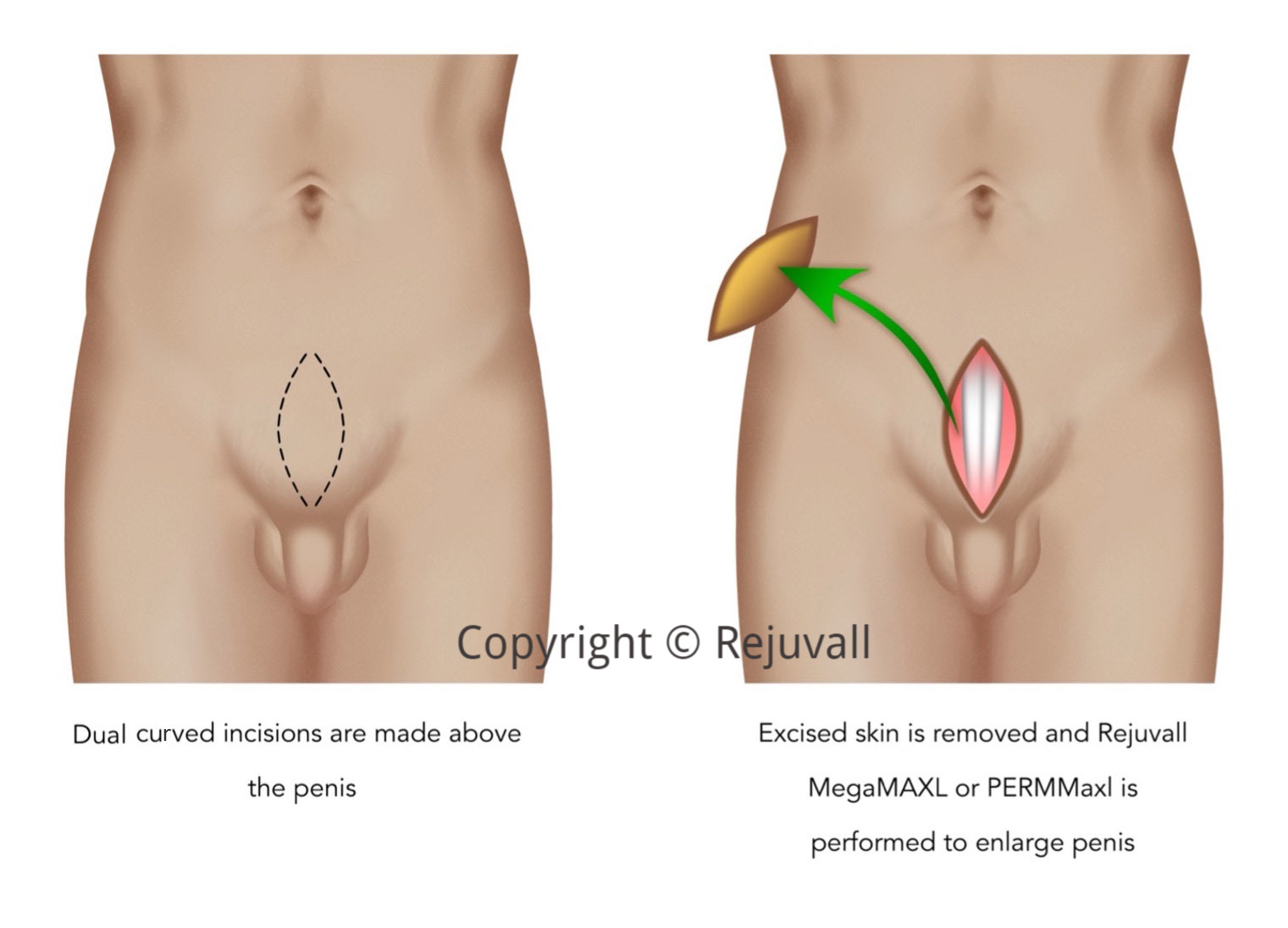 surgery remove fat pad pictures extend penis