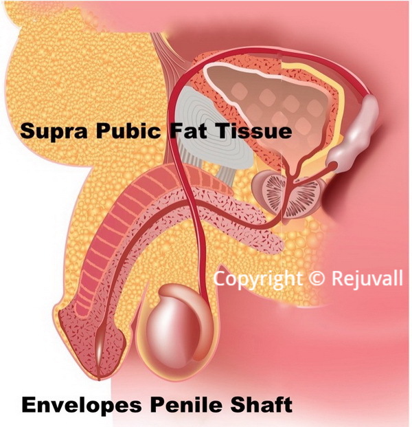 urologist trapped penis picture diagram