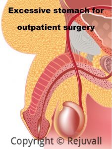 outpatient surgery extend penile length turtling penis picture