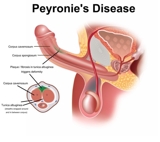Infographic Peyronie’s Disease