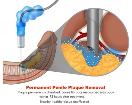 peyronies treatment medical pictures