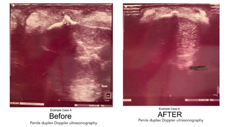 Medical removal of penile plaque photo