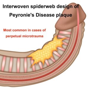 Penile trauma and Peyronie’s