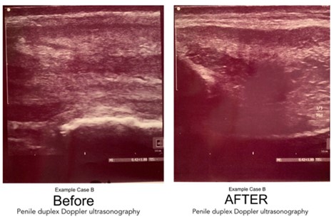 before after ultrasound photos peyronies