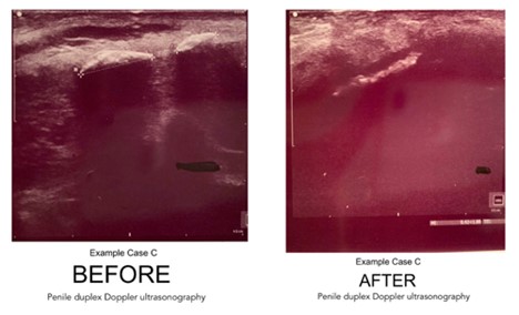 ultrasound photos after peyronies